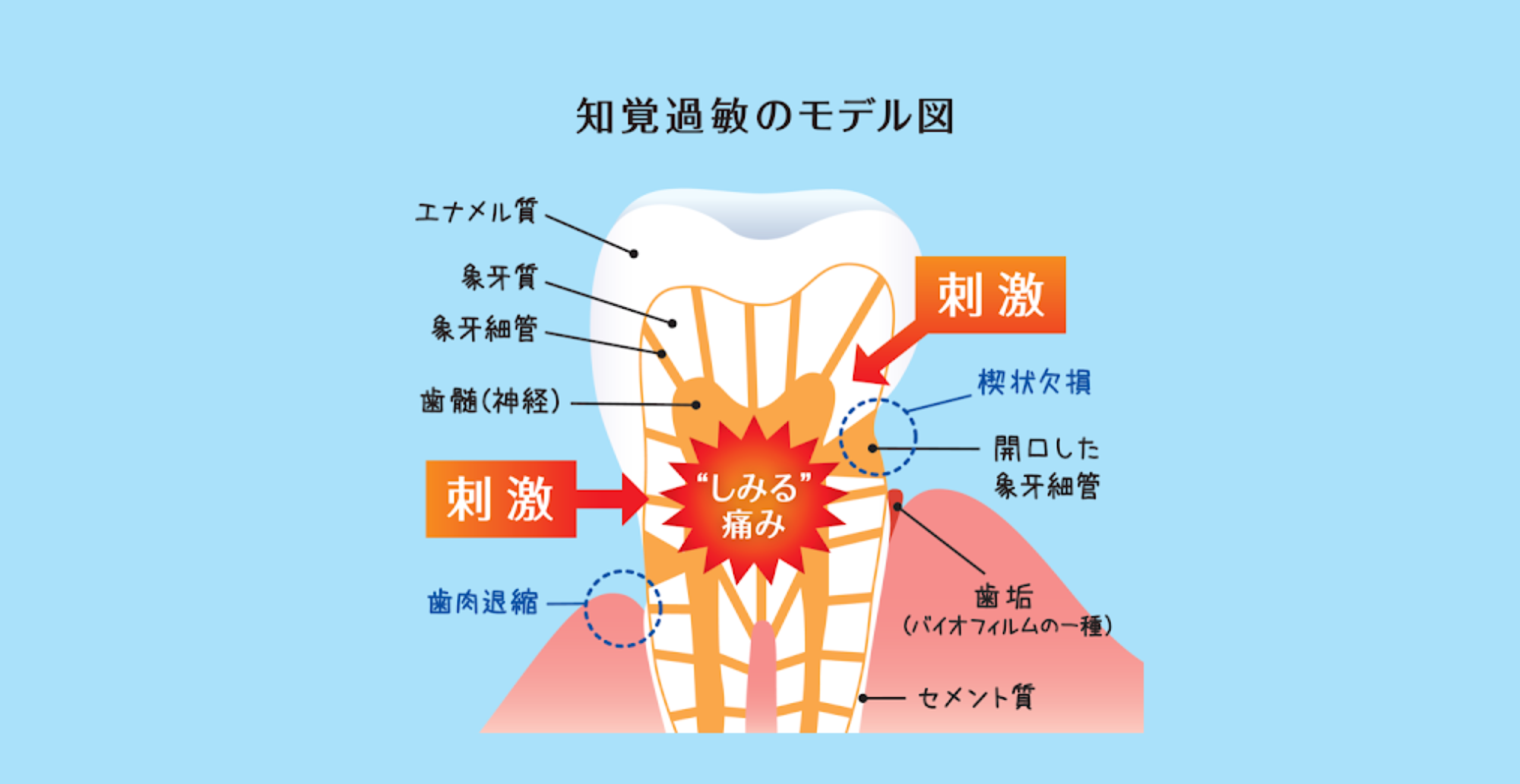 知覚過敏